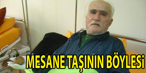 300 Gramlık Mesane Taşı