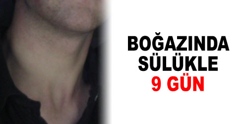 Boğazındaki Sülükle 9 Gün